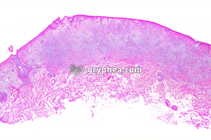 Carcinome cell - gryphea.org